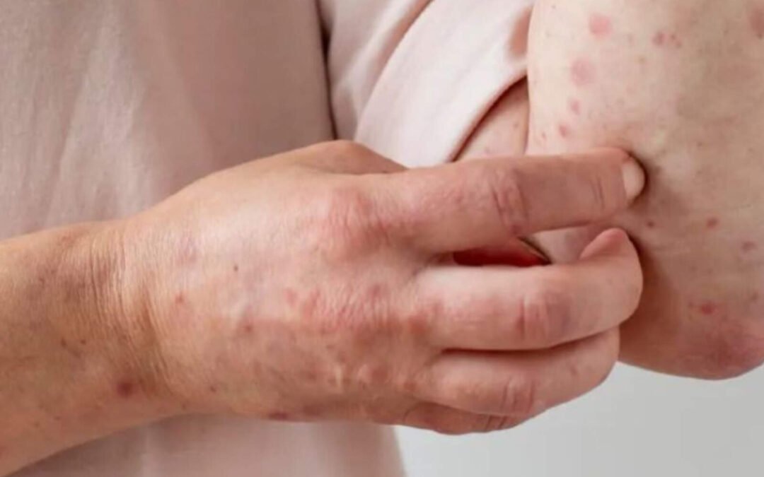 Todo lo que tenés que saber sobre el Sarampión en 2025