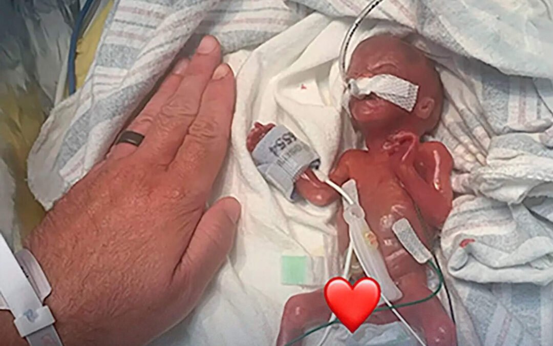 Un bebé nació con 21 semanas y rompió el récord como el más prematuro del mundo