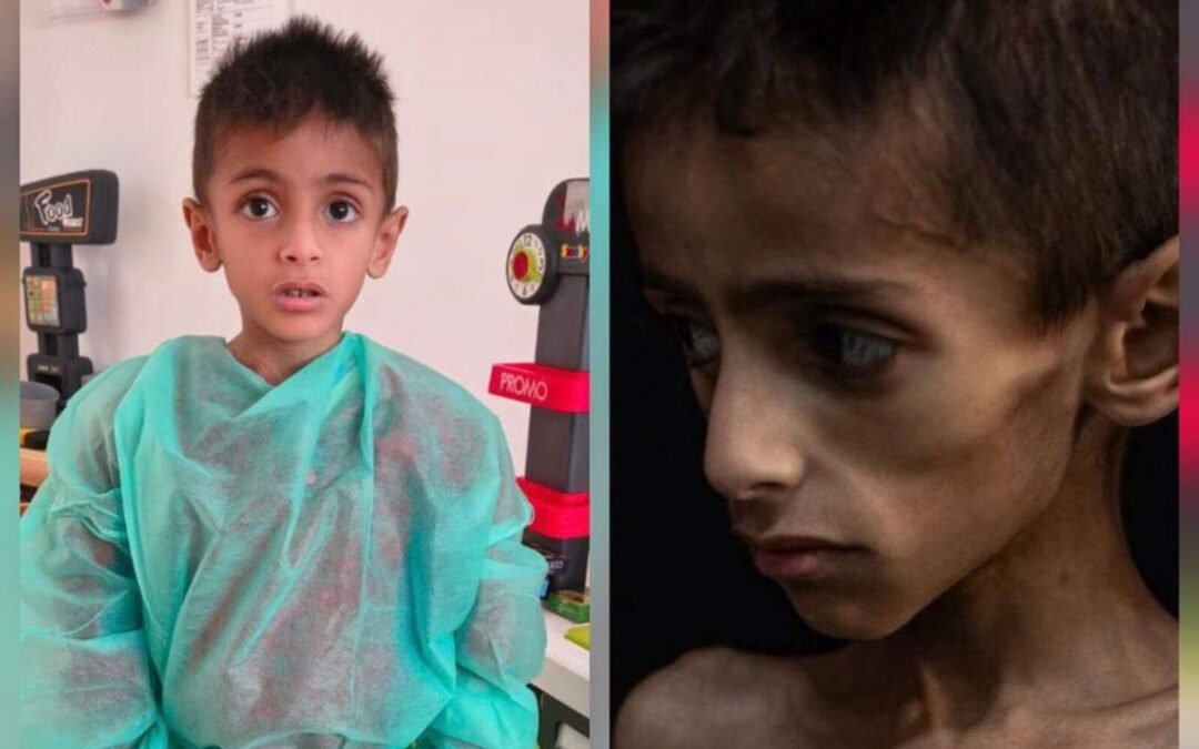 Otra falsa imagen de un niño desnutrido desnuda el aparato de propaganda de Hamas